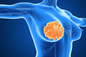 乳腺增生防治：身体发出的信号要注意！