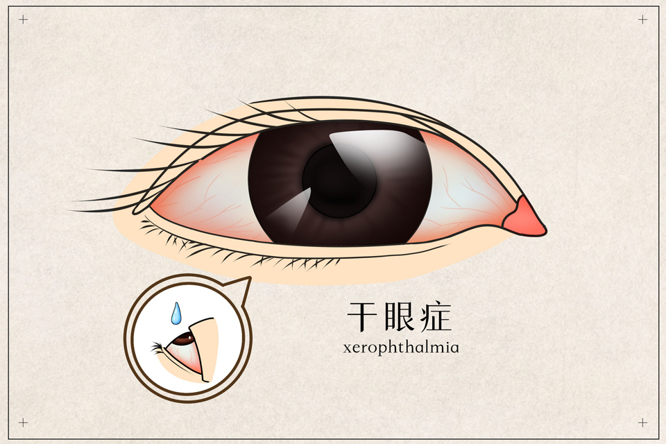 有过干眼症还能买健康保险吗？