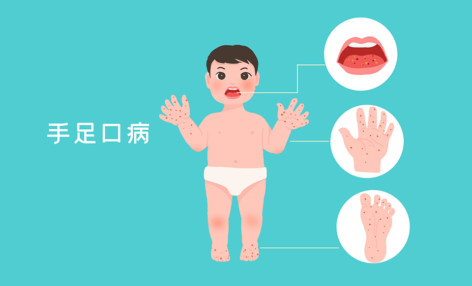 孩子得过手足口病还能买保险吗？