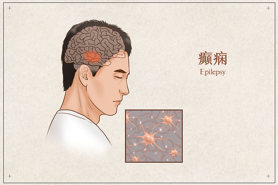 孩子有癫痫可以买重疾险吗